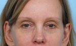 Eye Rejuvenation