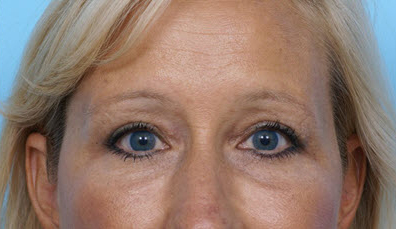 Eye Rejuvenation