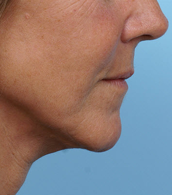 Face Lift/ Mini Lift/ Neck Lift