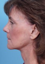 Face Lift/ Mini Lift/ Neck Lift