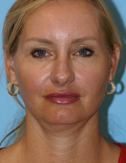 Face Lift/ Mini Lift/ Neck Lift