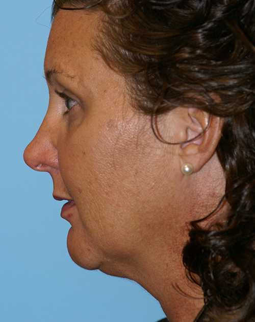 Face Lift/ Mini Lift/ Neck Lift