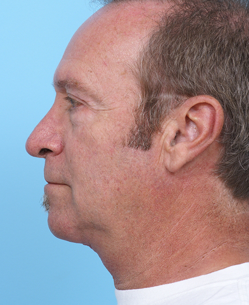 Face Lift/ Mini Lift/ Neck Lift