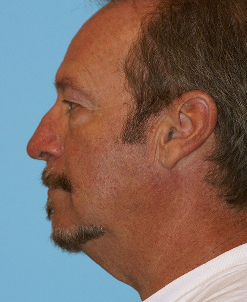 Face Lift/ Mini Lift/ Neck Lift