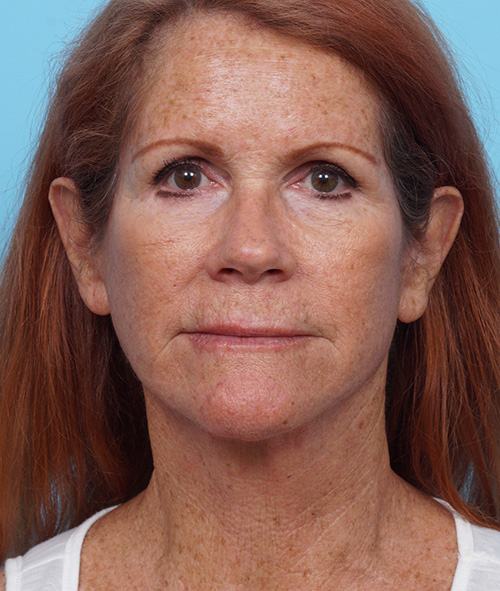 Face Lift/ Mini Lift/ Neck Lift