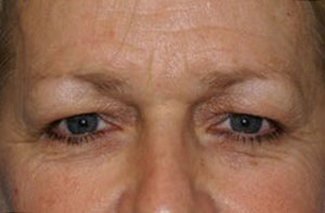 Eye Rejuvenation