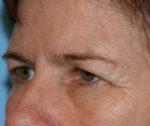 Eye Rejuvenation