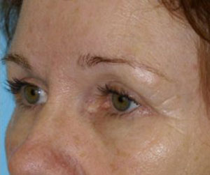 Eye Rejuvenation