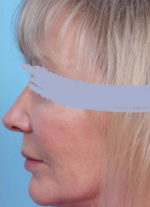 Rhinoplasty