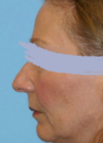 Rhinoplasty