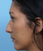 Rhinoplasty