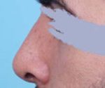 Rhinoplasty