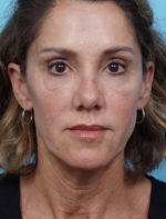 Face Lift/ Mini Lift/ Neck Lift