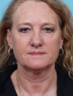Face Lift/ Neck Lift