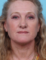 Face Lift/ Neck Lift
