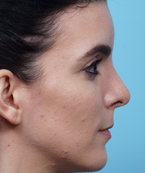 Rhinoplasty