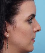 Rhinoplasty