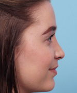 Rhinoplasty