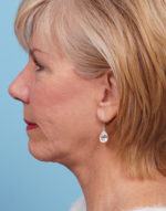 Face Lift/ Mini Lift/ Neck Lift