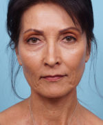 Face Lift/ Mini Lift/ Neck Lift