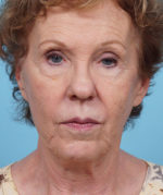 Face Lift/ Neck Lift