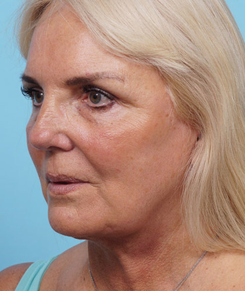 Face Lift/ Mini Lift/ Neck Lift