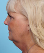 Face Lift/ Mini Lift/ Neck Lift