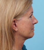 Face Lift/ Mini Lift/ Neck Lift