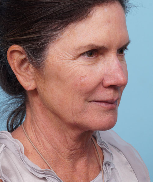 Face Lift/ Neck Lift