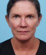 Face Lift/ Neck Lift