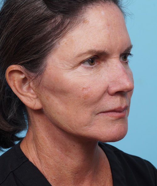 Face Lift/ Neck Lift