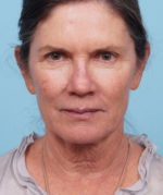 Face Lift/ Neck Lift