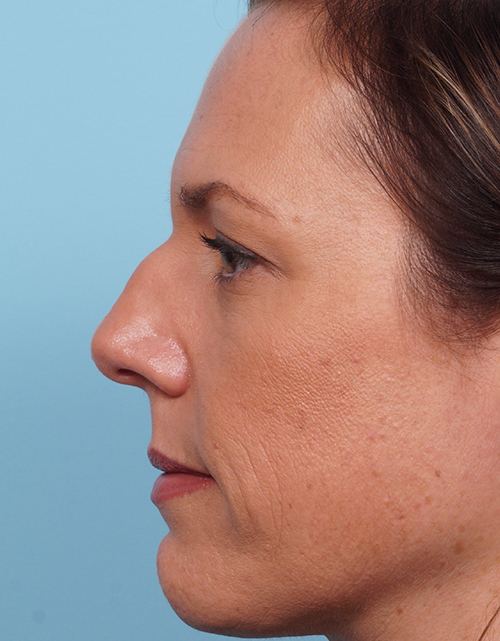 Rhinoplasty