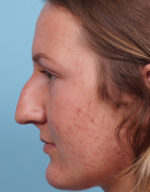 Rhinoplasty