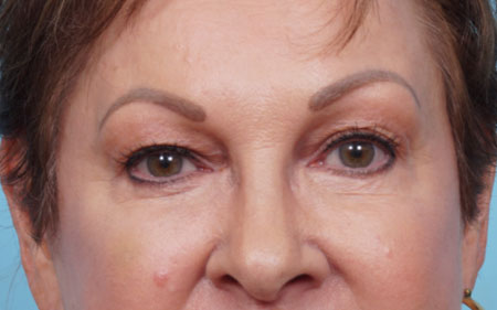 Eye Rejuvenation