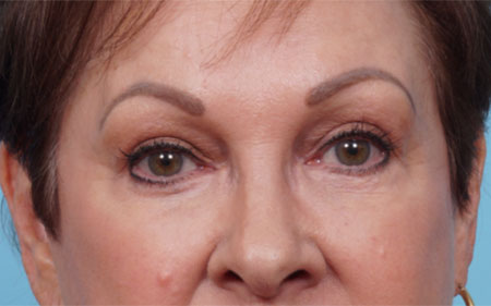 Eye Rejuvenation