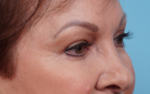 Eye Rejuvenation