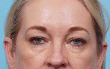 Eye Rejuvenation