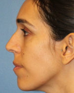 Rhinoplasty