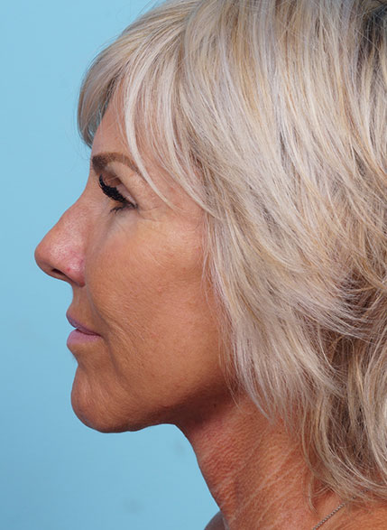 Face Lift/ Mini Lift/ Neck Lift