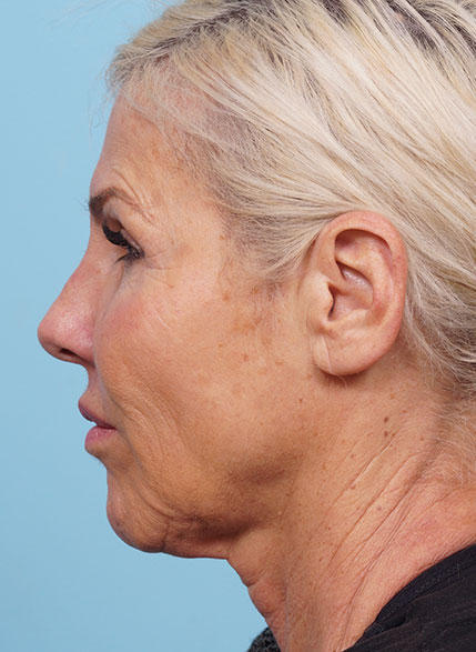 Face Lift/ Mini Lift/ Neck Lift