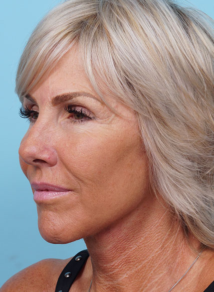 Face Lift/ Mini Lift/ Neck Lift