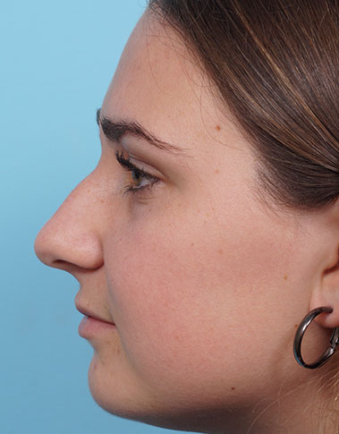 Rhinoplasty