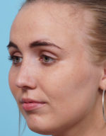 Rhinoplasty