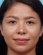 Rhinoplasty