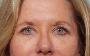 Eye Rejuvenation