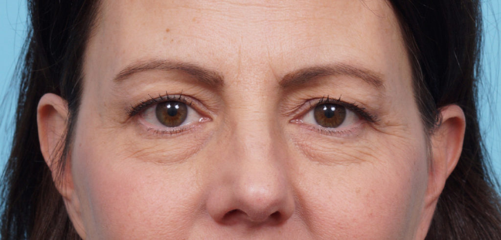 Eye Rejuvenation