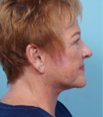 Face Lift/ Mini Lift/ Neck Lift