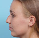 Rhinoplasty