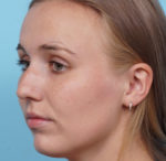 Rhinoplasty